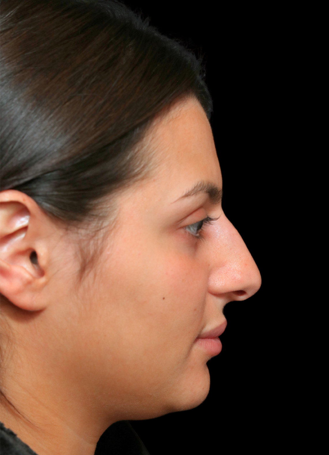 Rhinoplasty Before and After | Dr. Ashlin Alexander