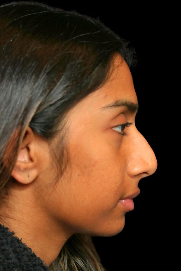 Rhinoplasty Before and After | Dr. Ashlin Alexander