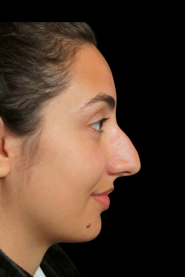 Rhinoplasty Before and After | Dr. Ashlin Alexander