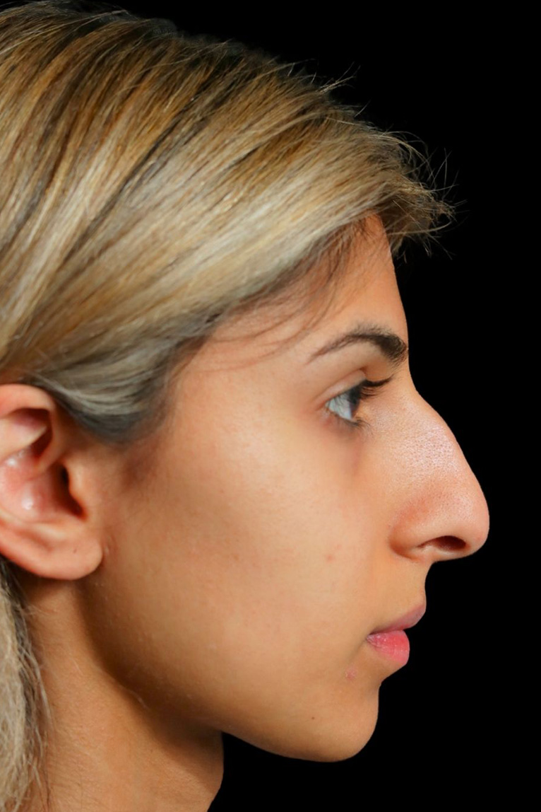 Rhinoplasty Before and After | Dr. Ashlin Alexander