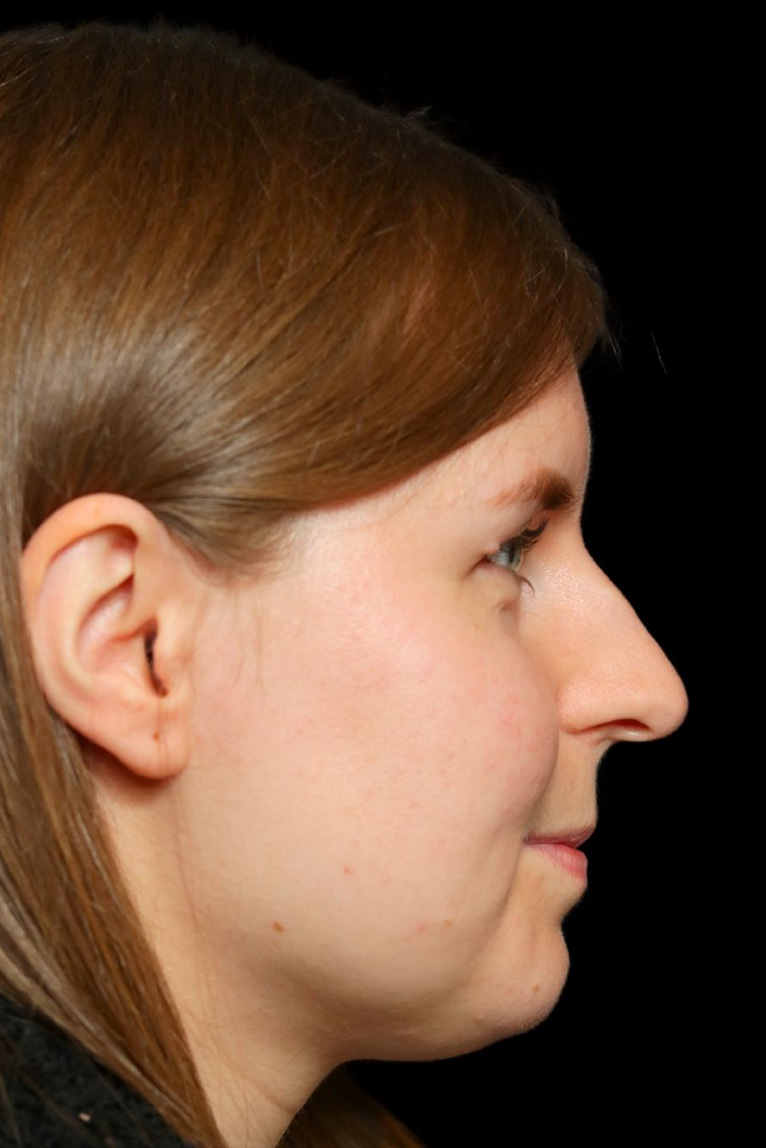 Rhinoplasty Before and After | Dr. Ashlin Alexander