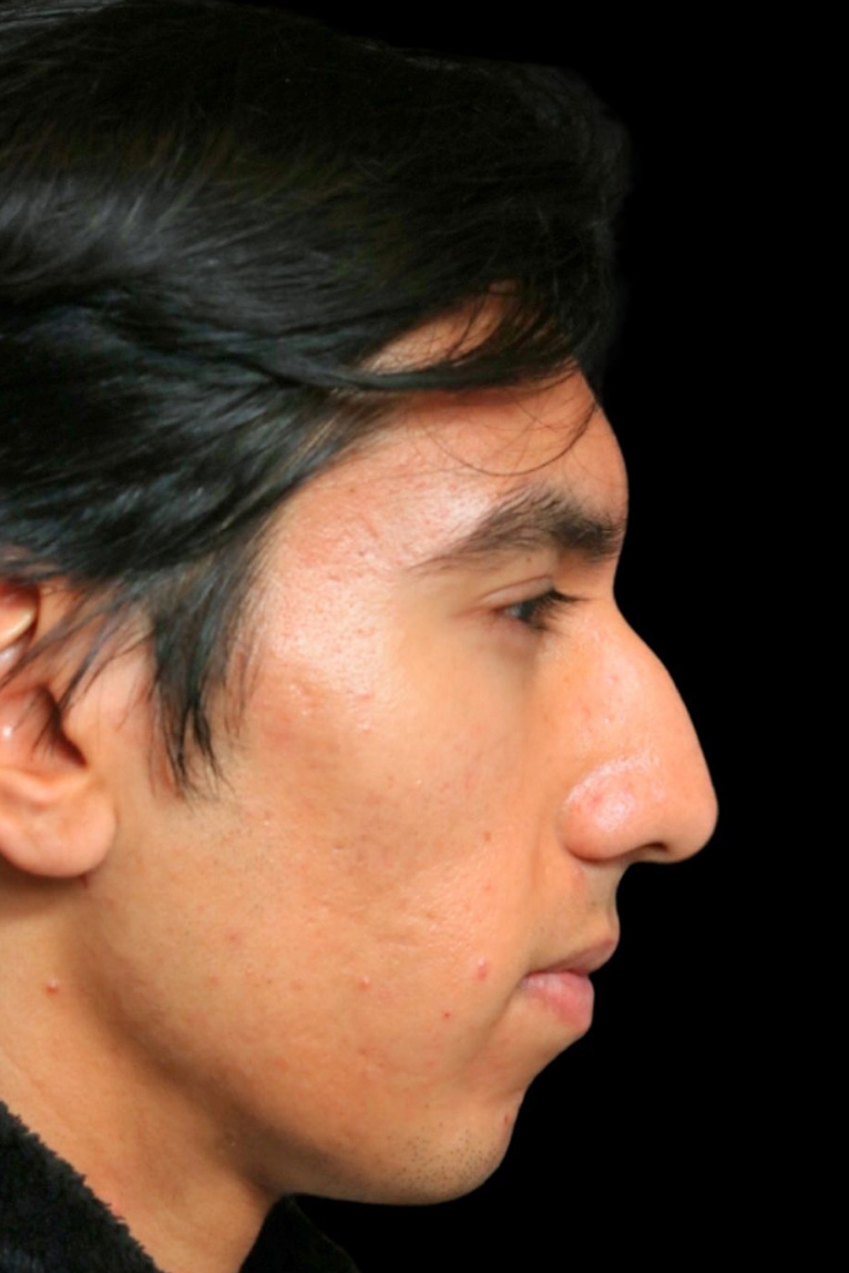 Rhinoplasty Before and After | Dr. Ashlin Alexander
