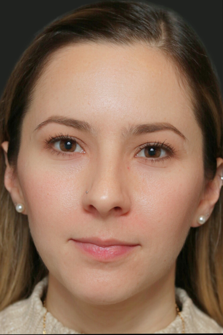 Rhinoplasty Before and After | Dr. Ashlin Alexander