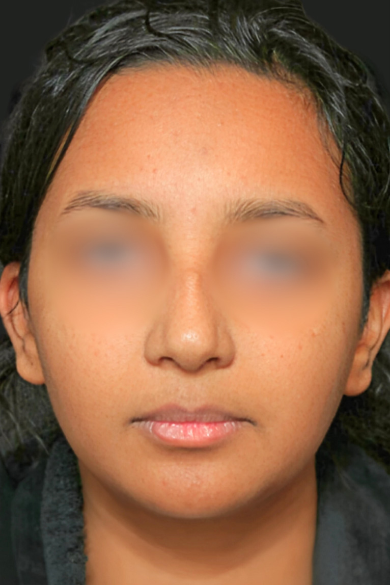 Rhinoplasty Before and After | Dr. Ashlin Alexander