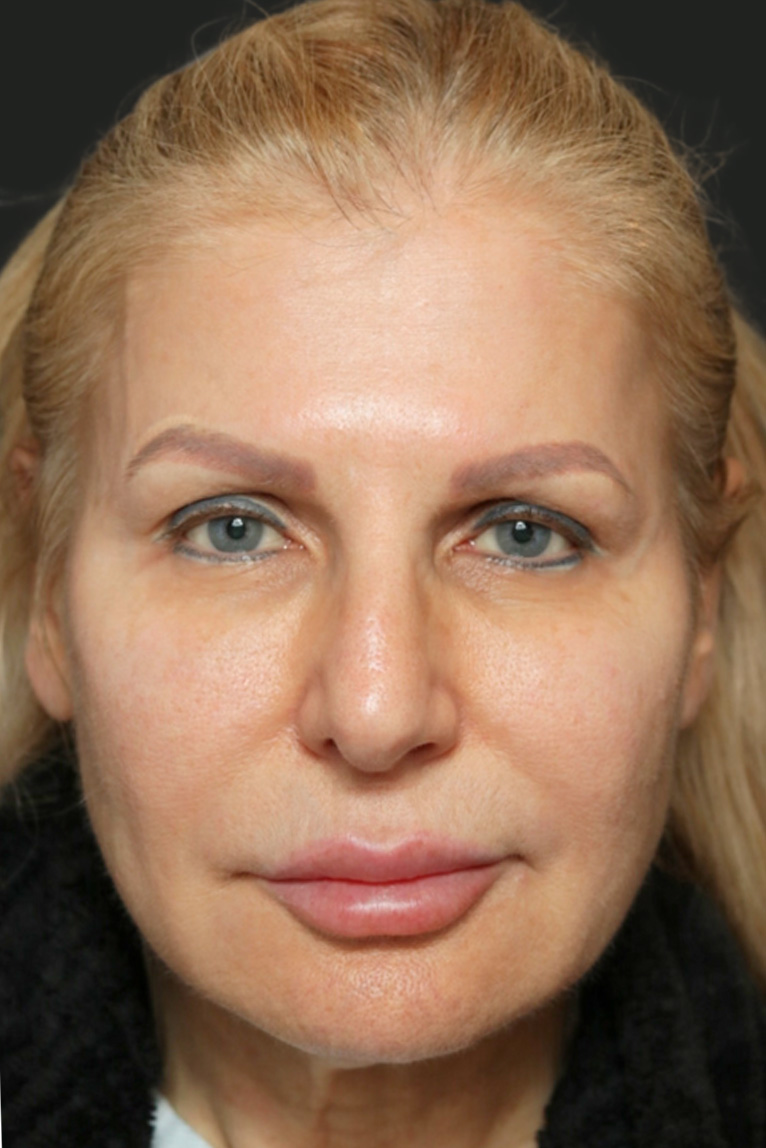 Rhinoplasty Before and After | Dr. Ashlin Alexander