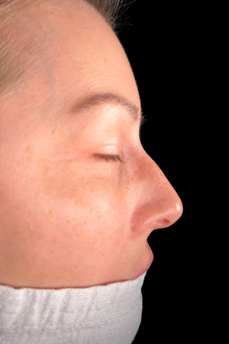 Rhinoplasty Before and After | Dr. Ashlin Alexander