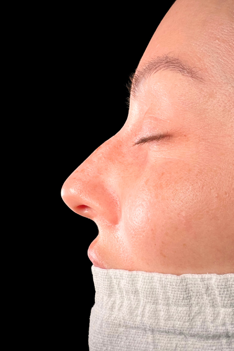 Rhinoplasty Before and After | Dr. Ashlin Alexander