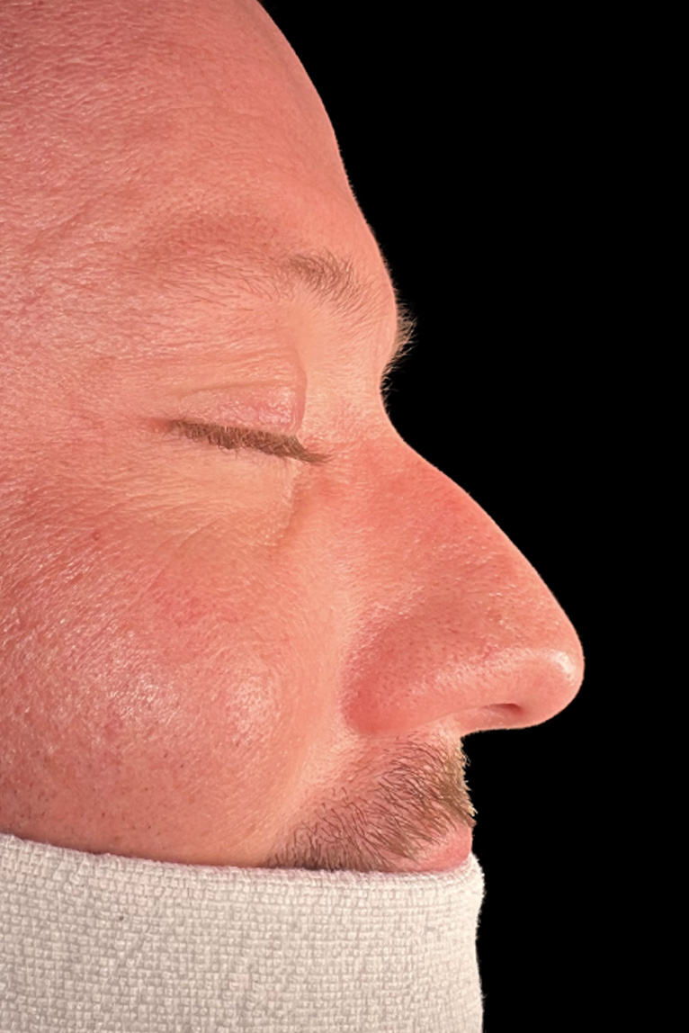 Rhinoplasty Before and After | Dr. Ashlin Alexander