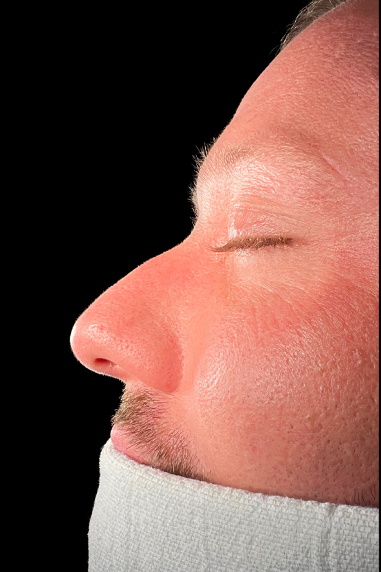 Rhinoplasty Before and After | Dr. Ashlin Alexander