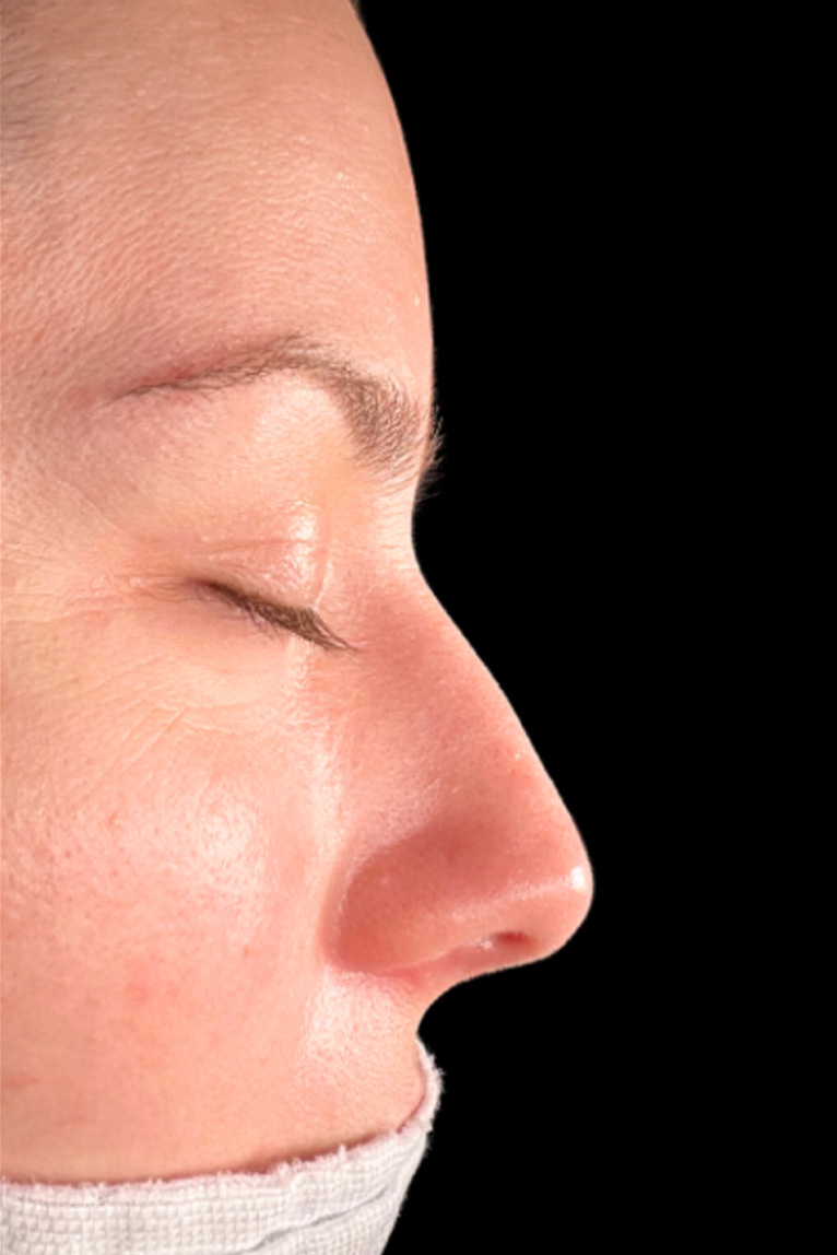 Rhinoplasty Before and After | Dr. Ashlin Alexander