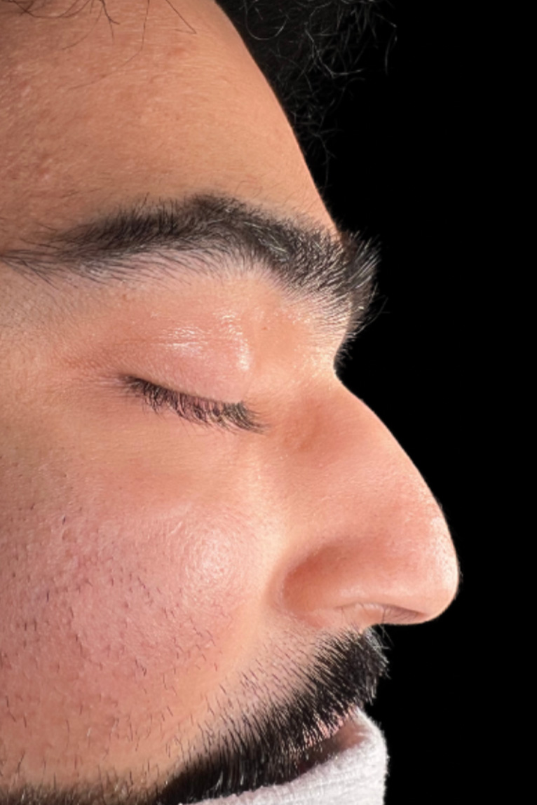 Rhinoplasty Before and After | Dr. Ashlin Alexander