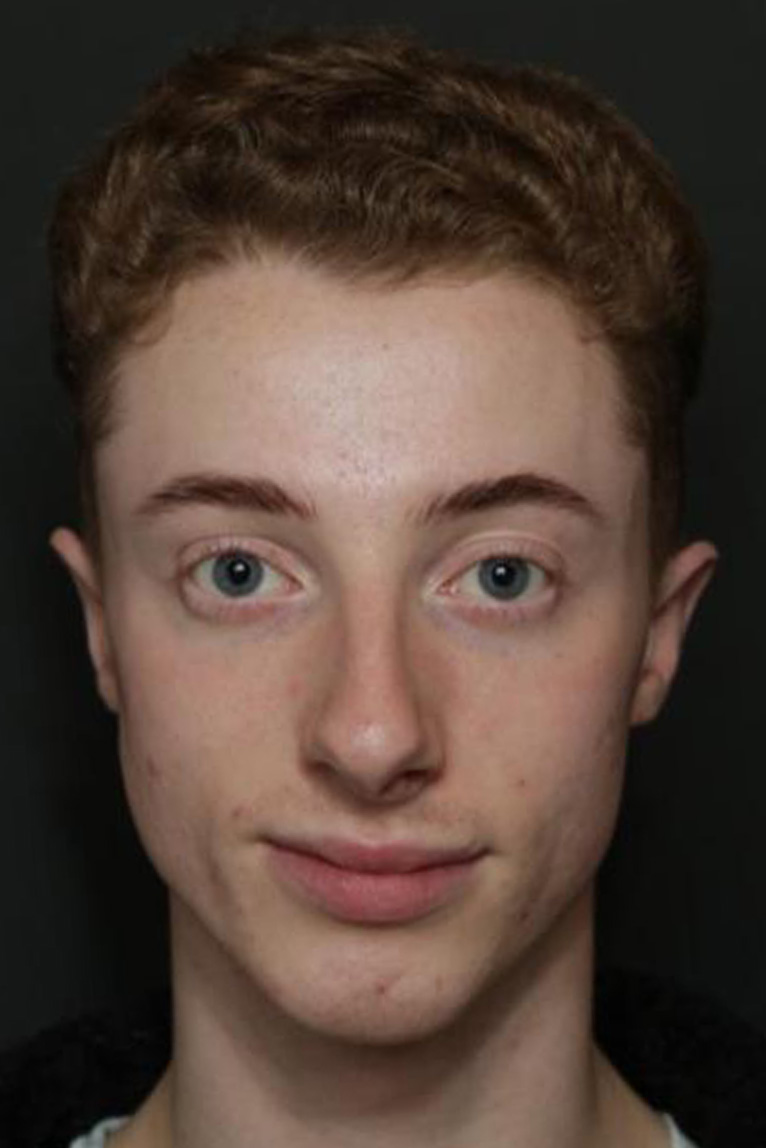 Rhinoplasty Before and After | Dr. Ashlin Alexander