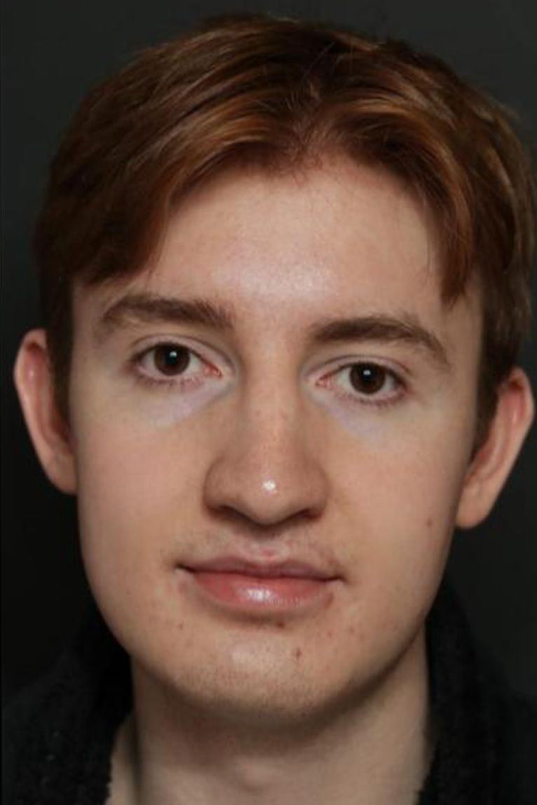 Rhinoplasty Before and After | Dr. Ashlin Alexander