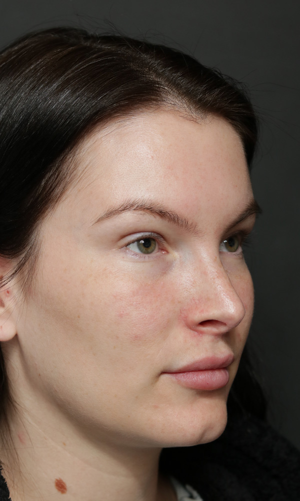 Rhinoplasty Before and After | Dr. Ashlin Alexander