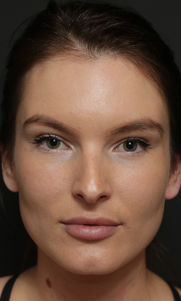 Rhinoplasty Before and After | Dr. Ashlin Alexander