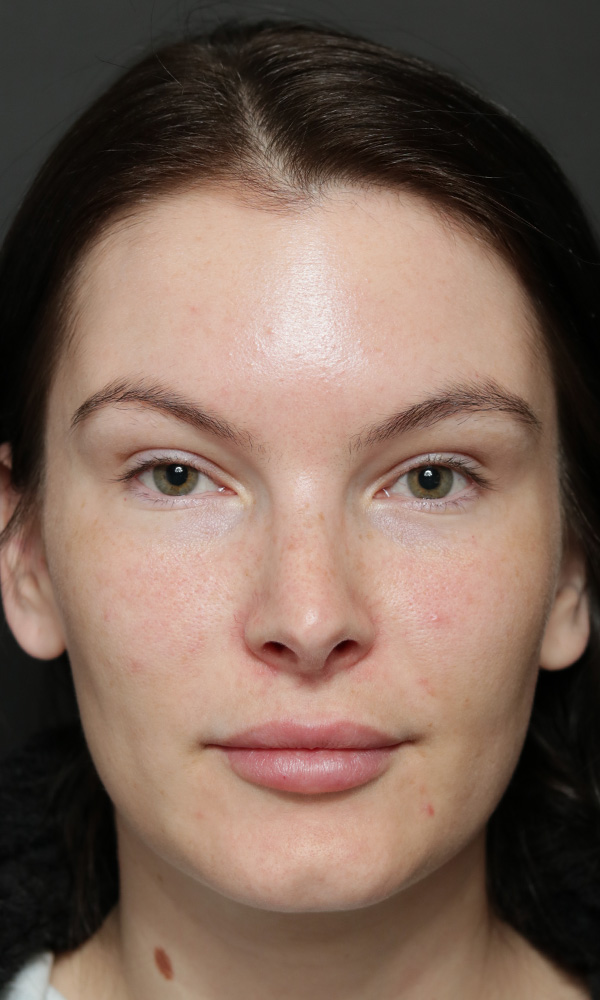 Rhinoplasty Before and After | Dr. Ashlin Alexander