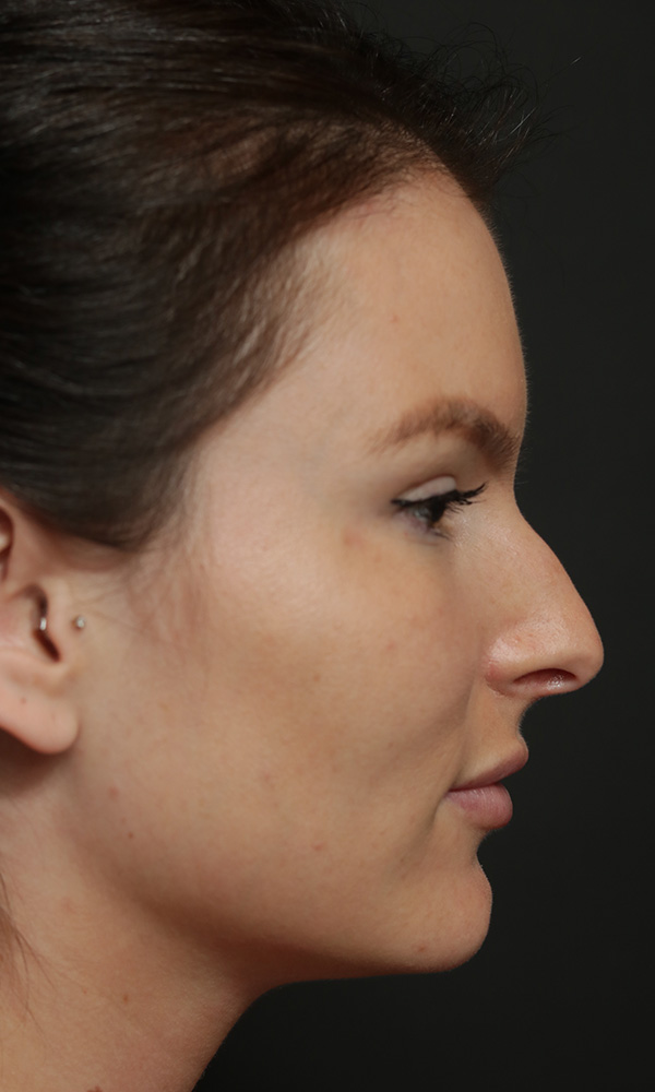 Rhinoplasty Before and After | Dr. Ashlin Alexander