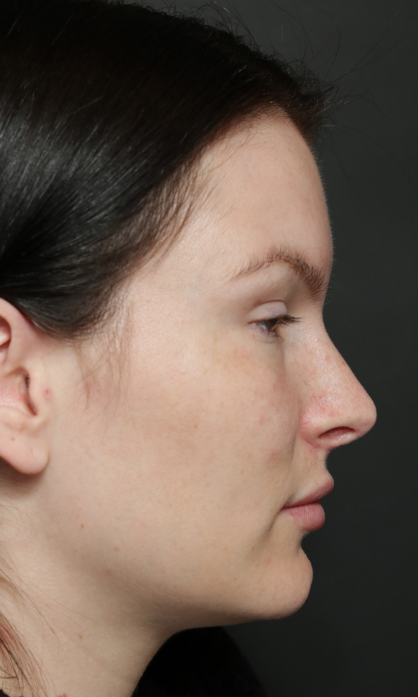 Rhinoplasty Before and After | Dr. Ashlin Alexander