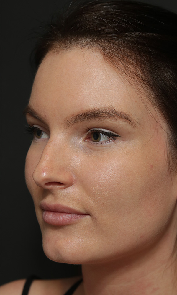 Rhinoplasty Before and After | Dr. Ashlin Alexander