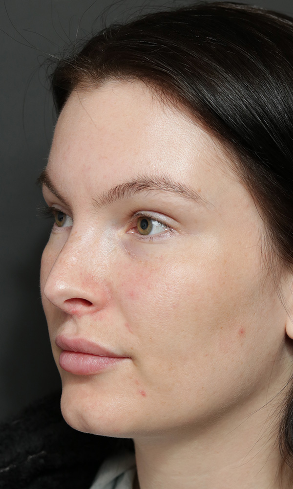 Rhinoplasty Before and After | Dr. Ashlin Alexander