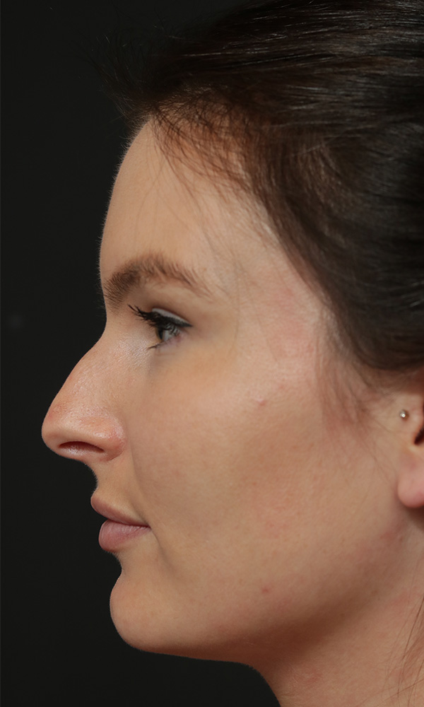 Rhinoplasty Before and After | Dr. Ashlin Alexander