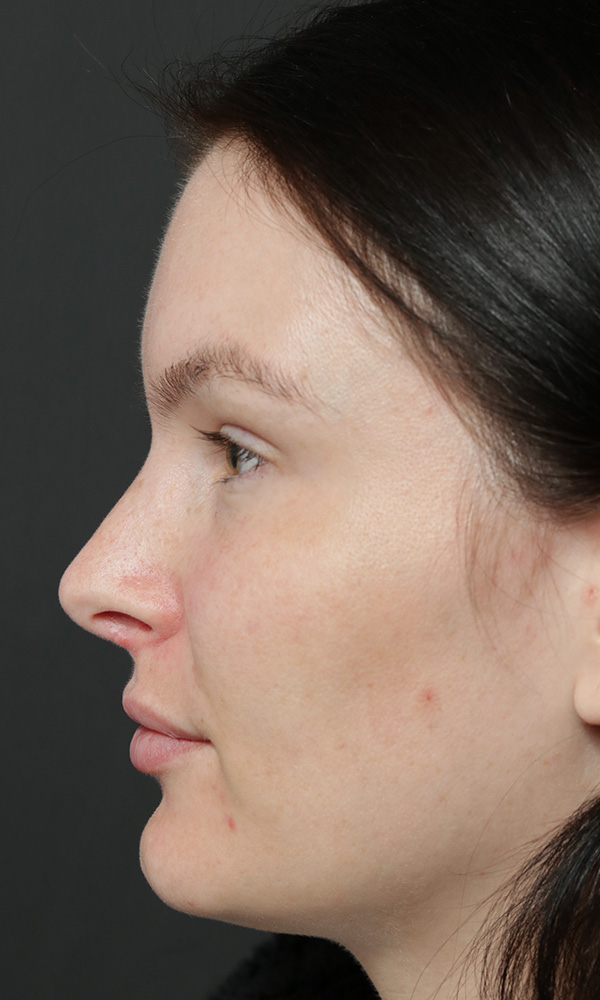 Rhinoplasty Before and After | Dr. Ashlin Alexander