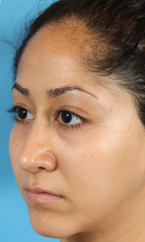 Rhinoplasty Before and After | Dr. Ashlin Alexander