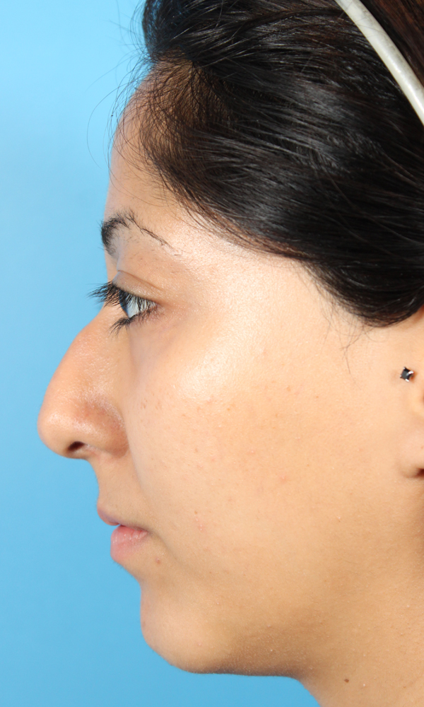 Rhinoplasty Before and After | Dr. Ashlin Alexander