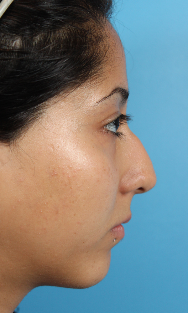 Rhinoplasty Before and After | Dr. Ashlin Alexander