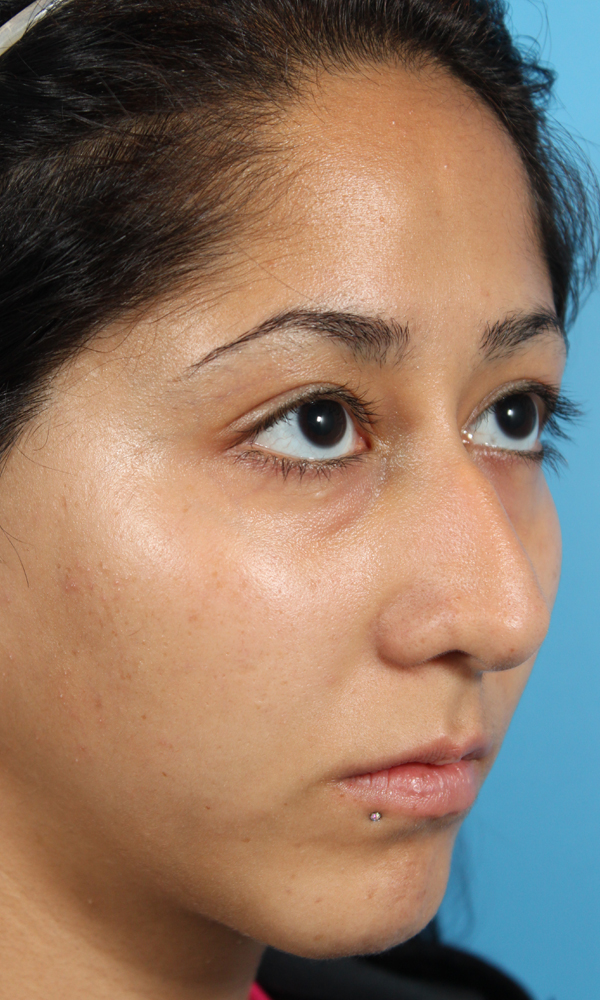 Rhinoplasty Before and After | Dr. Ashlin Alexander