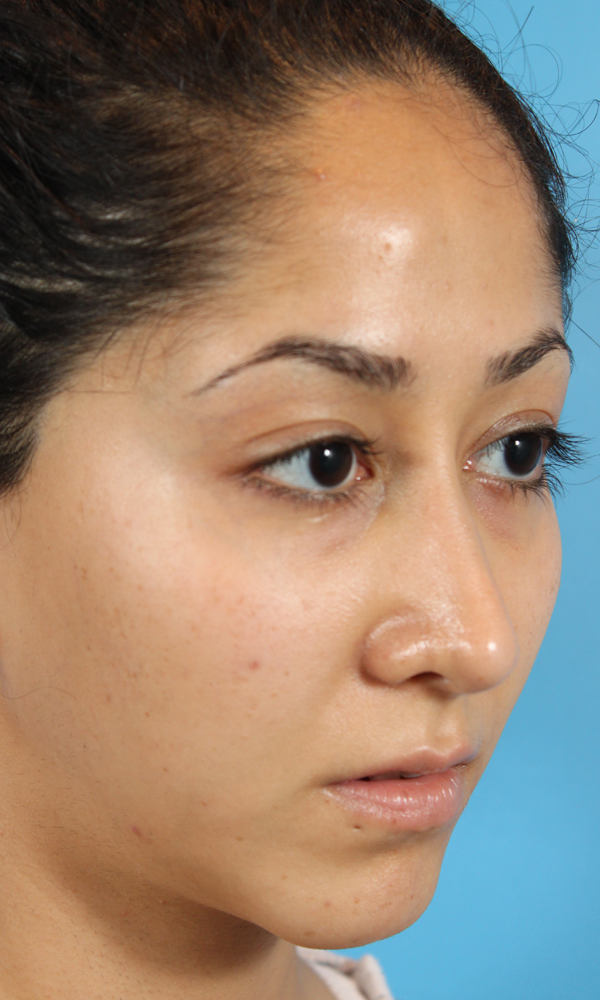 Rhinoplasty Before and After | Dr. Ashlin Alexander