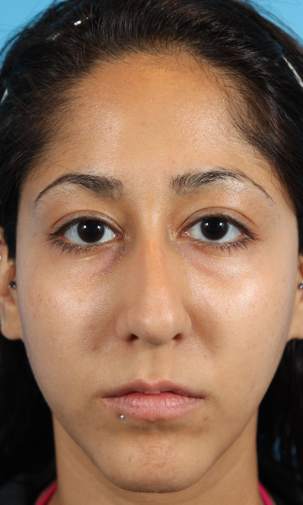 Rhinoplasty Before and After | Dr. Ashlin Alexander