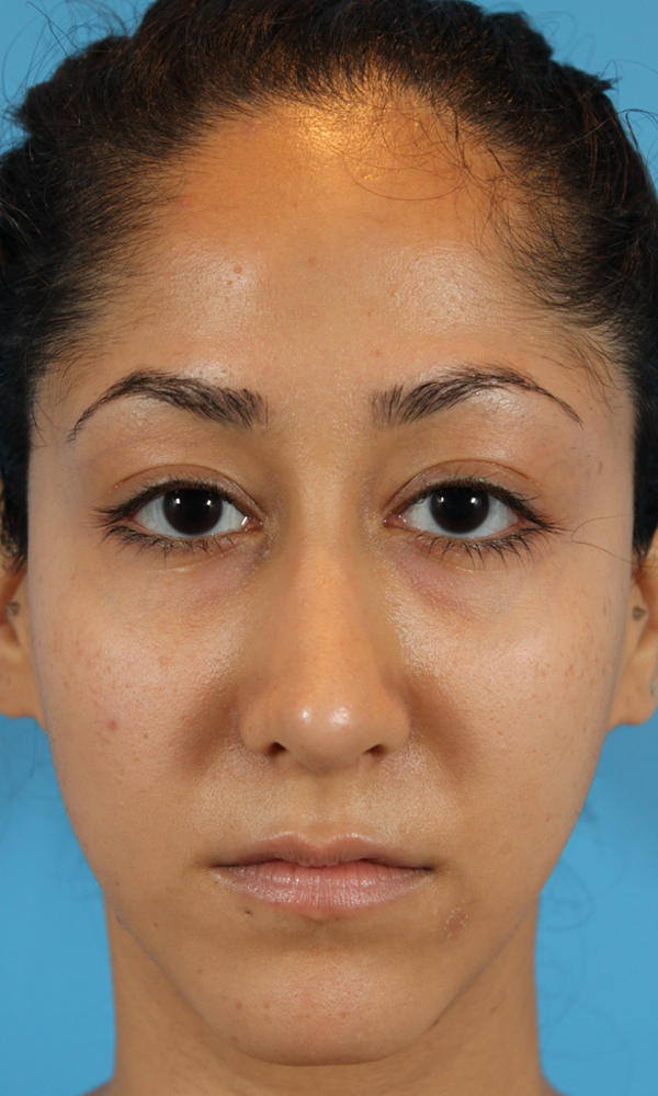 Rhinoplasty Before and After | Dr. Ashlin Alexander