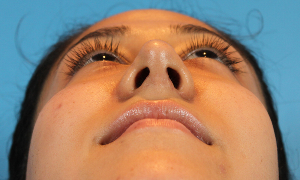 Rhinoplasty Before and After | Dr. Ashlin Alexander