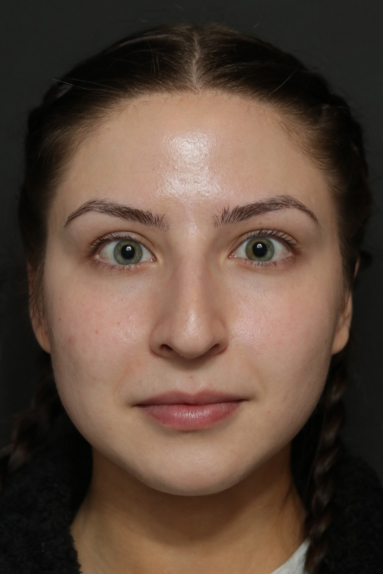 Rhinoplasty Before and After | Dr. Ashlin Alexander