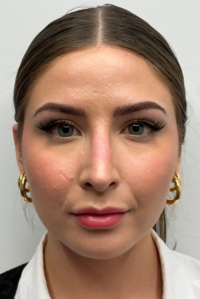 Rhinoplasty Before and After | Dr. Ashlin Alexander