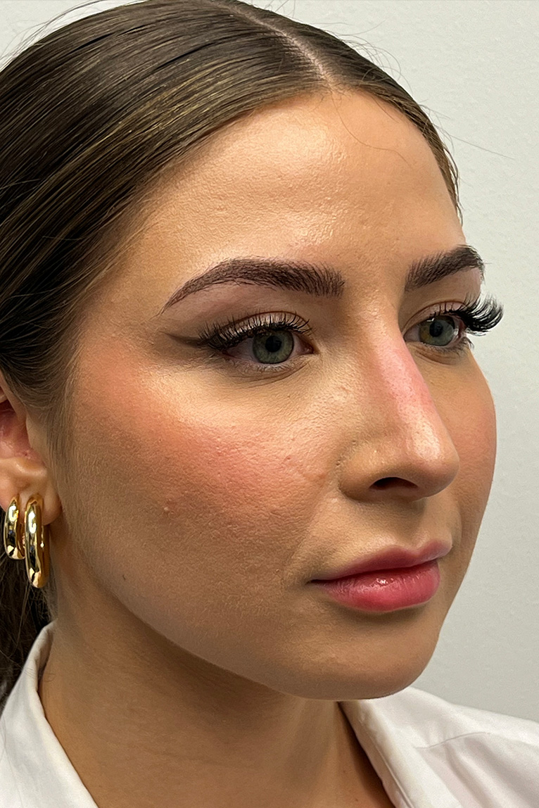 Rhinoplasty Before and After | Dr. Ashlin Alexander