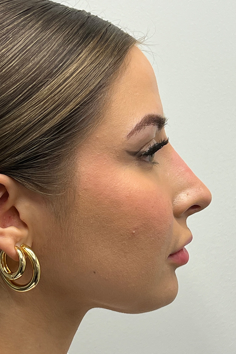 Rhinoplasty Before and After | Dr. Ashlin Alexander