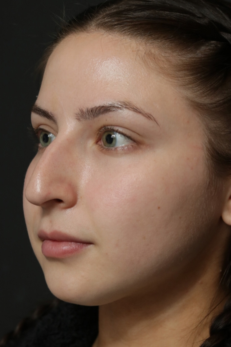 Rhinoplasty Before and After | Dr. Ashlin Alexander