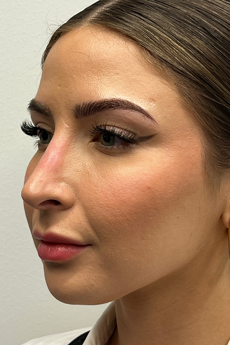 Rhinoplasty Before and After | Dr. Ashlin Alexander