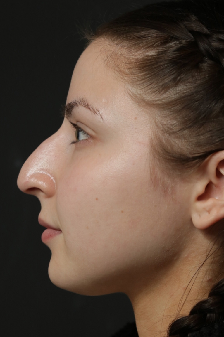 Rhinoplasty Before and After | Dr. Ashlin Alexander
