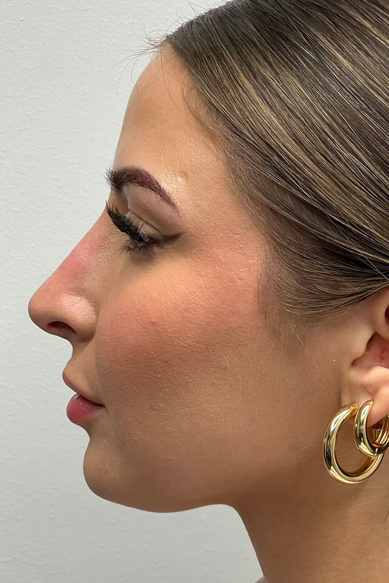 Rhinoplasty Before and After | Dr. Ashlin Alexander
