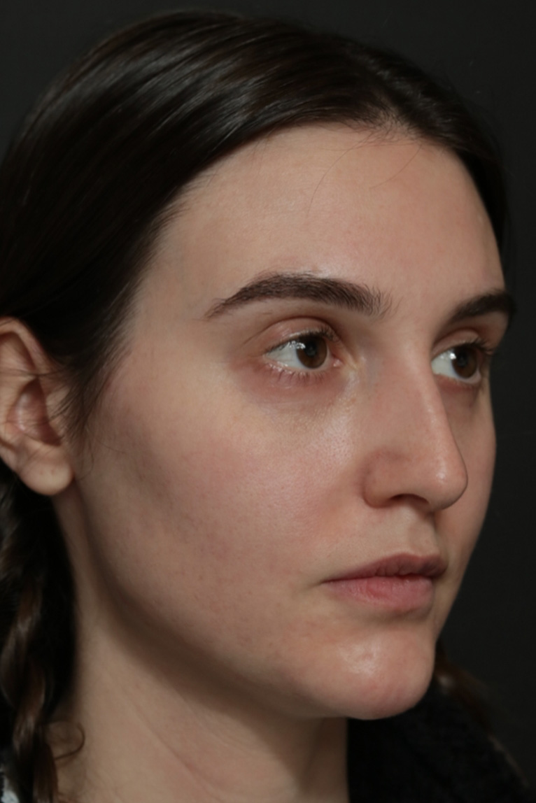 Rhinoplasty Before and After | Dr. Ashlin Alexander