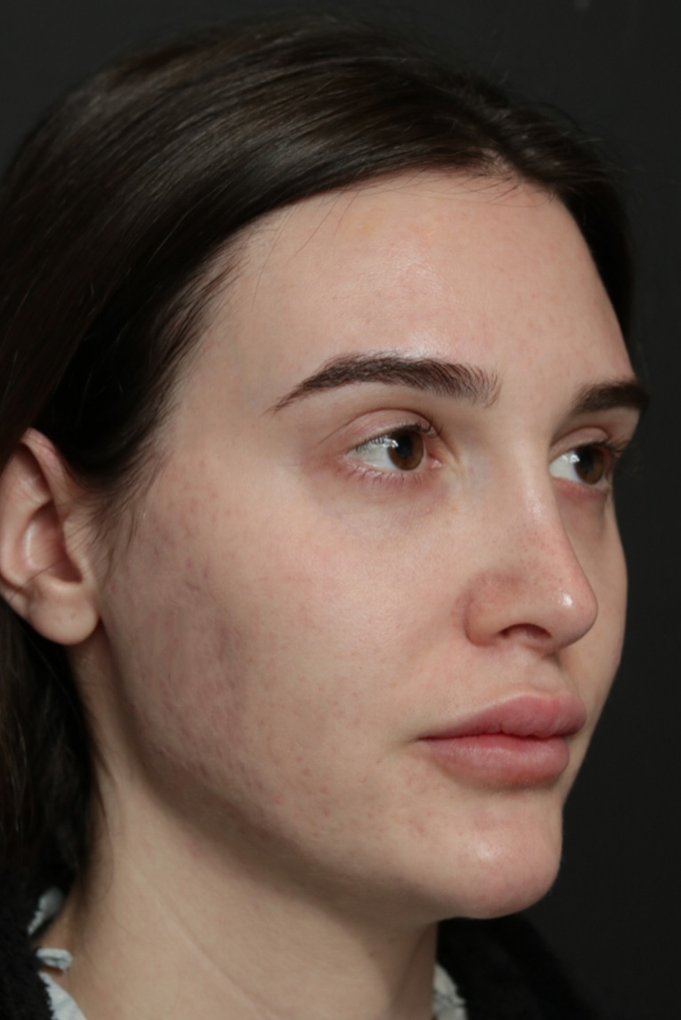 Rhinoplasty Before and After | Dr. Ashlin Alexander
