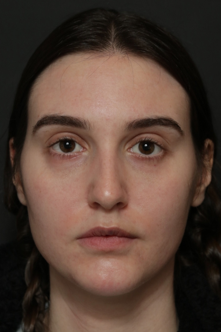 Rhinoplasty Before and After | Dr. Ashlin Alexander