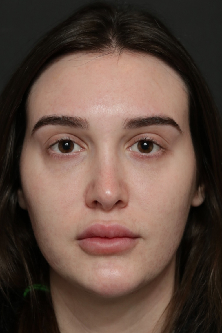 Rhinoplasty Before and After | Dr. Ashlin Alexander