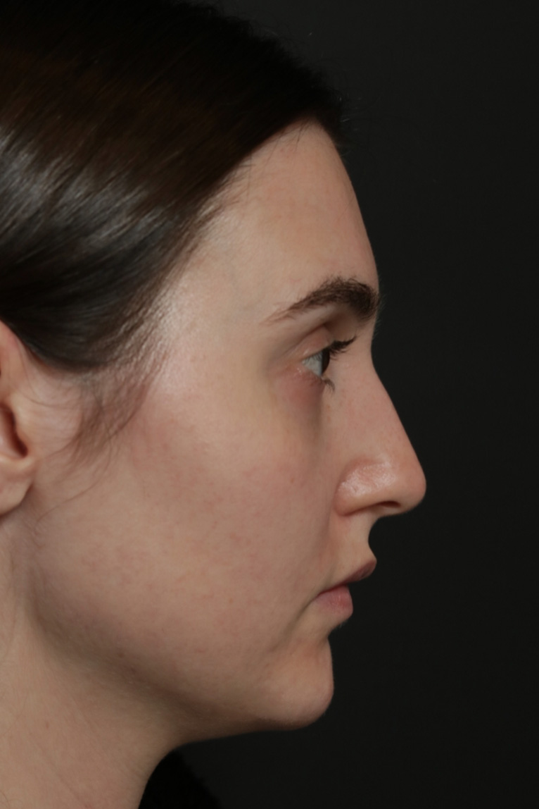 Rhinoplasty Before and After | Dr. Ashlin Alexander