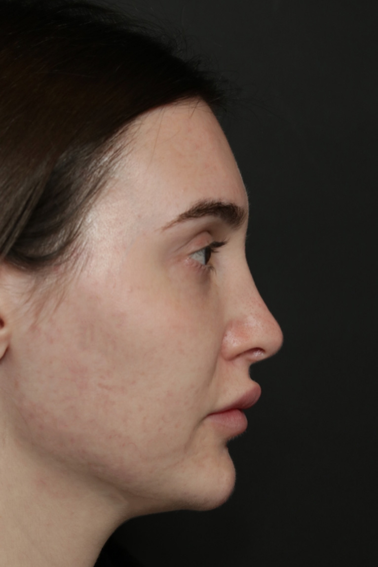 Rhinoplasty Before and After | Dr. Ashlin Alexander