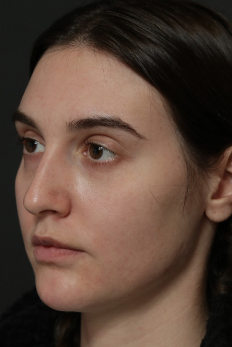 Rhinoplasty Before and After | Dr. Ashlin Alexander