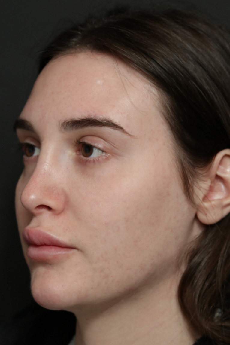 Rhinoplasty Before and After | Dr. Ashlin Alexander